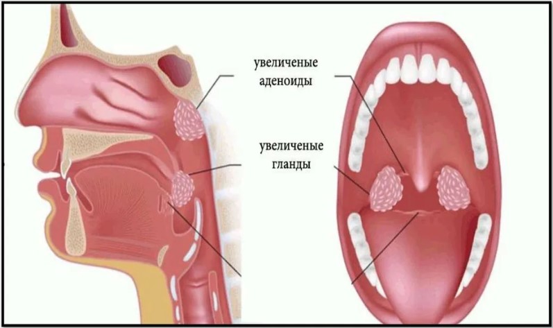 Где находятся аденоиды у ребенка картинка
