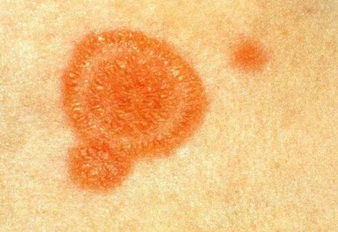 Отрубевидный лишай у человека на коже как выглядит